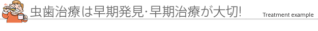 虫歯治療は早期発見・早期治療が大切です!